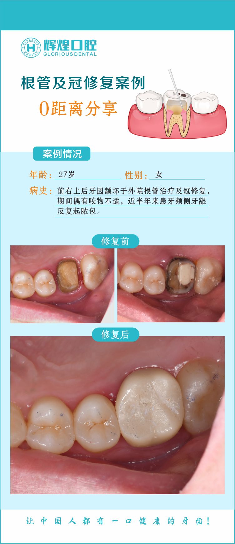 上后牙因龋坏于外院根管治疗及冠修复，近半年来患牙颊侧牙龈反复起脓包，到我院根管治疗及冠修复