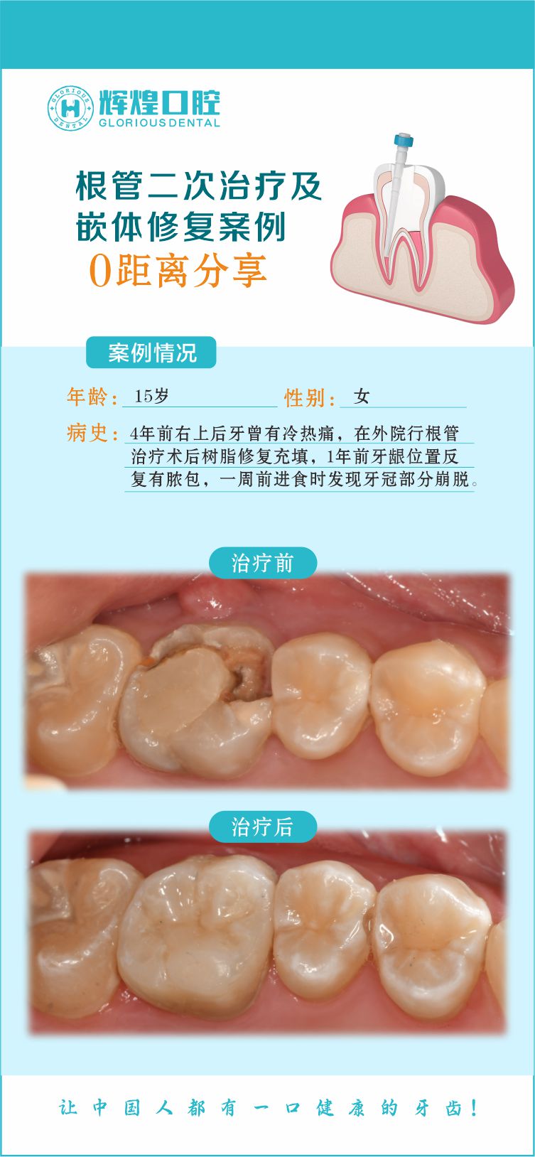 4年前前右上后牙曾有冷热痛，在外院行根管治疗术后树脂修复充填，1年前牙龈位置反复有脓包，一周前进食时发现牙冠部分崩脱，到我院二次根管修复及冠体修复