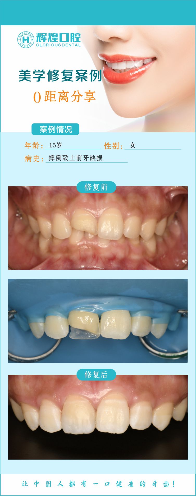摔倒致上牙缺损美学修复案例