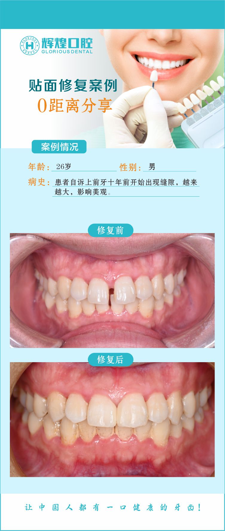 前门牙出现缝隙贴面修复